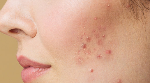 Simple Tips to Prevent pimples : మొటిమలు నివారించే సింపుల్‌ చిట్కాలు