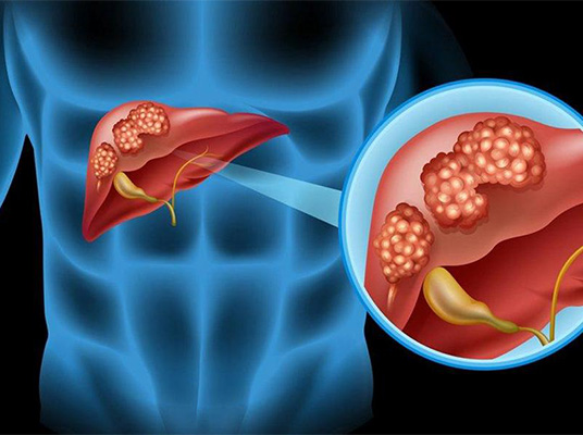 Liver Problems : ఇవి తింటే ఇక మీ లివర్‌ పని అంతే