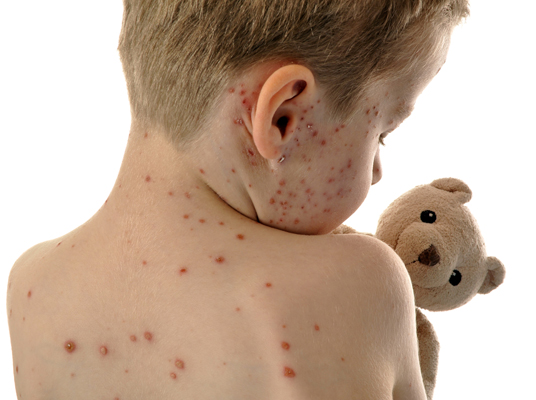 Measles In Mumbai : ప్రాణాంతకంగా మారిన మీజిల్స్.. చిన్నారులకు డేంజర్..