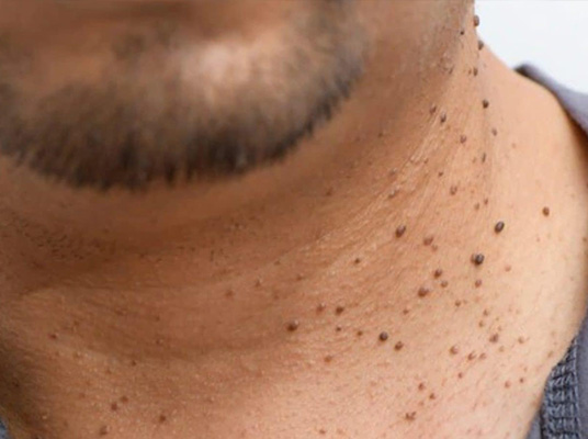 Pimples : 3 రోజుల్లో పులిపిర్లు రాలిపోయే చిట్కాలు