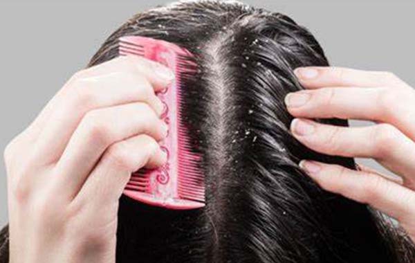 Tips for Dandruff : ఇలా చేస్తే చుండ్రు ఉండదు