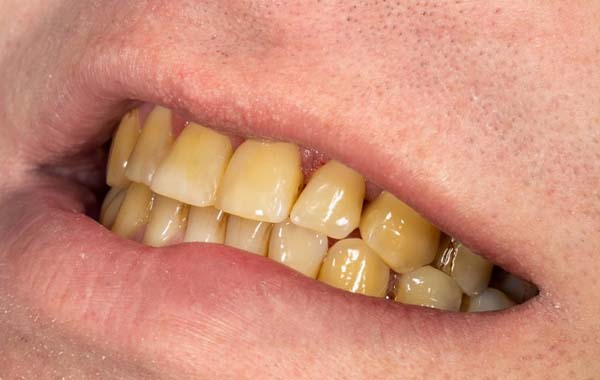 Teeth Grinding in Sleep: నిద్రలో మీకు పళ్లు కొరికే అలవాటు ఉందా?