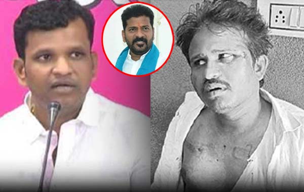 BRS MLA : లాయర్ పై ఎమ్మెల్యే గాదరి కిషోర్ అనుచరుల దాడి.. బాధితుడికి రేవంత్ పరామర్శ..