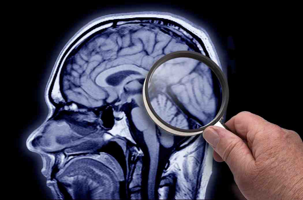 AI for Alzheimers Disease : ఏఐ సాయంతో అల్జీమర్స్ గుర్తింపుకు ప్రయత్నం..