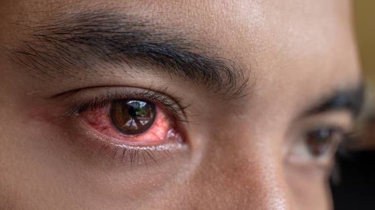 Conjunctivitis cases : కళ్ల కలకతో కలవరం.. వేలల్లో కేసులతో కలకలం..