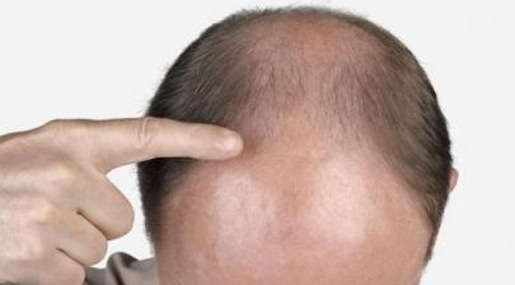 Bald Head Treatment : బట్టతల ఉందా.. అయితే చలో ఇస్తాంబుల్..!