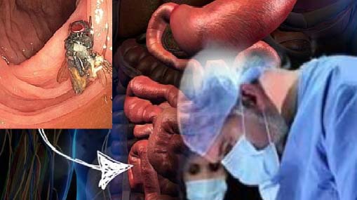 Fly in Man Intestines : వృద్ధుడి పేగుల్లో ఈగ.. షాక్ అయిన డాక్టర్లు