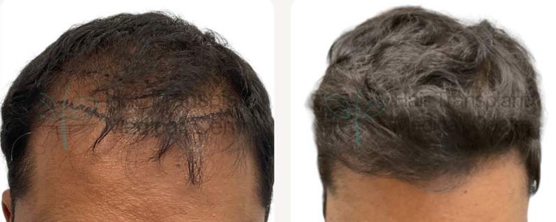 Hair Transplantation