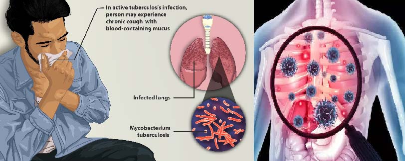 Tuberculosis- TB