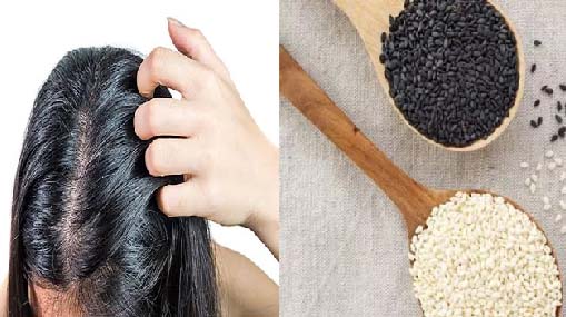 Hair Care : నల్ల నువ్వులు..చుండ్రుకు చెక్ ..