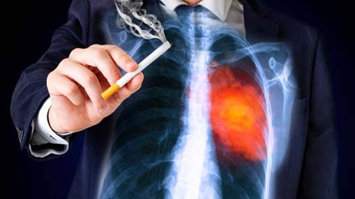 Lung Cancer : స్మోకింగ్ చేయకున్నా లంగ్ కేన్సర్‌