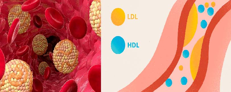 HDL-Dementia