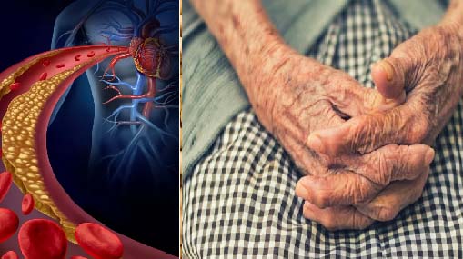 HDL-Dementia : గుడ్ కొలెస్ట్రాల్ ఎక్కువైనా ముప్పే!