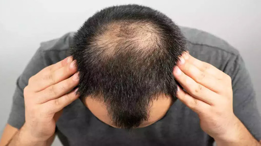 Hair Loss: ఈ డ్రింక్స్ తాగుతున్నారా.. అయితే బట్టతల రావడం ఖాయం!