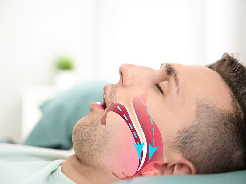 Sleep Apnea : స్లీప్ ఆప్నియా.. ఈ ఆహారాలతో గుడ్ బై చెప్పండి!