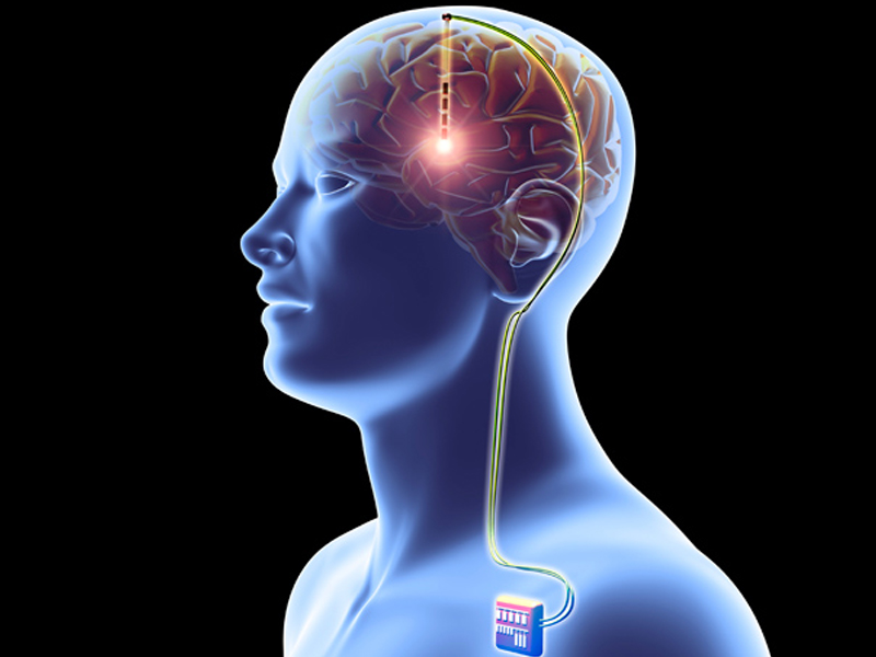 Brain Pacemaker for Depression: డిప్రెషన్‌ను తగ్గించే బ్రెయిన్ పేస్ మేకర్..