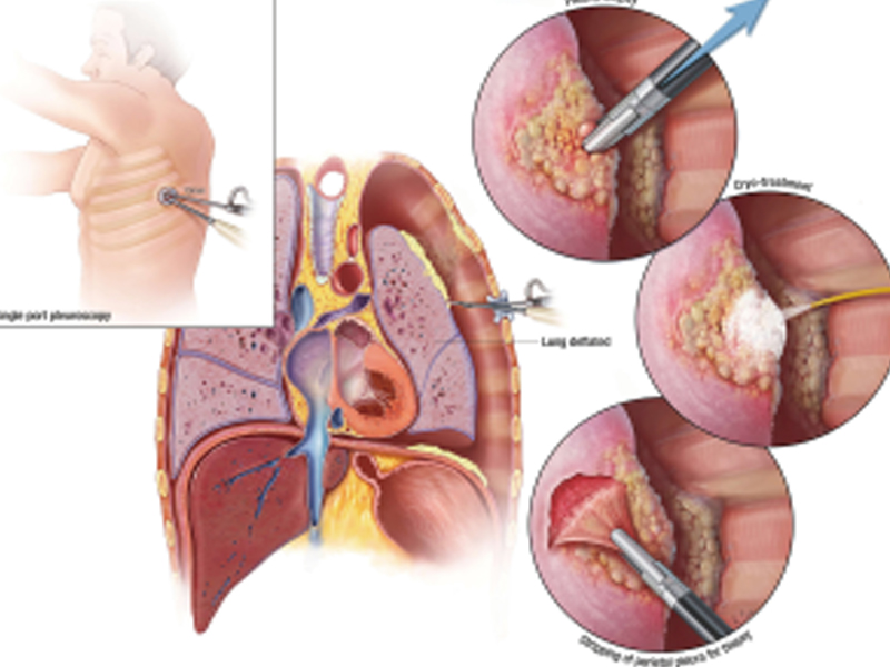 Caner Drug : మొండి కేన్సర్‌కు దివ్యౌషధం..