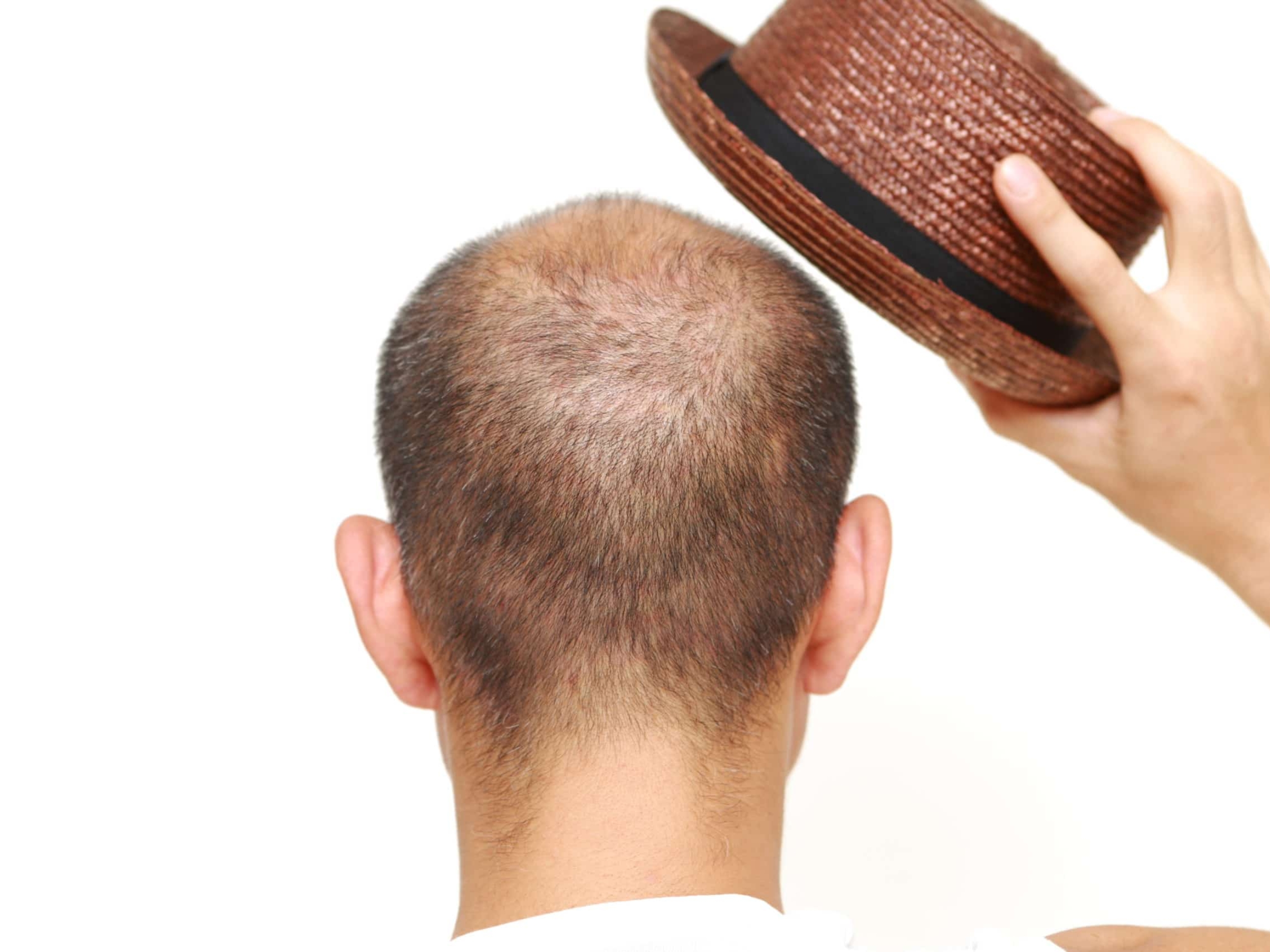 Hat Cause Hair Loss : క్యాప్ పెట్టుకుంటే జుట్టు రాలుతుందా..?