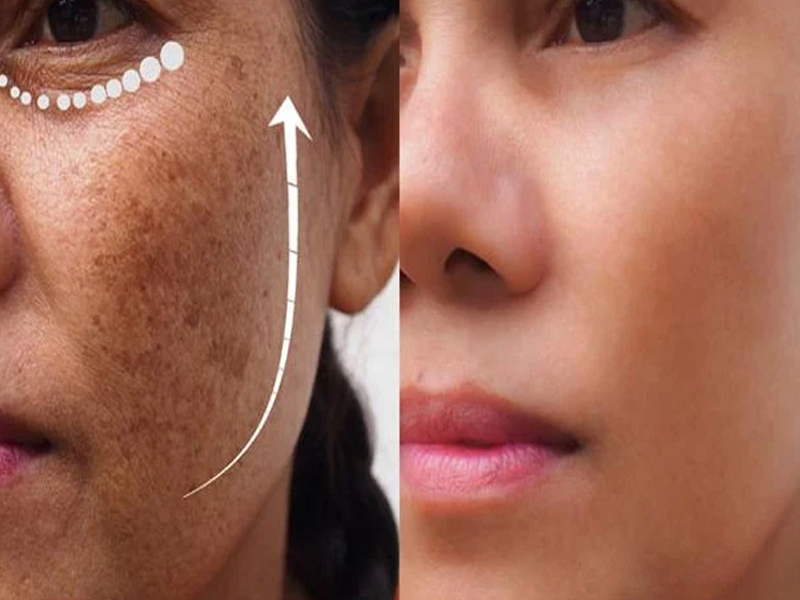 How To Remove Pigmentation on Face: మంగు మచ్చలతో ఇబ్బంది పడుతున్నారా.. అయితే ఇలా చేయండి