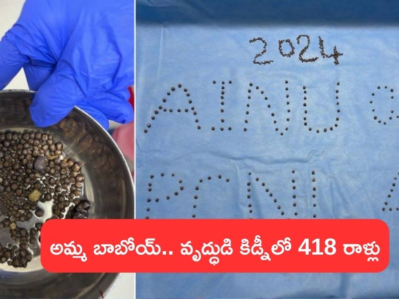 418 Stones in Kidney: నాలుగు రాళ్లు వెనకేసుకోమంటే.. మనోడు ఏకంగా కిడ్నీలో 400కి పైగా వెనకేసుకున్నాడట!