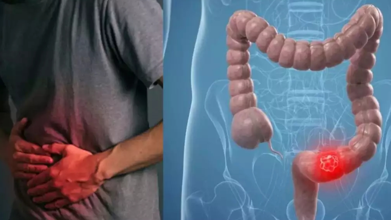 Colon Cancer in Youth: యువతకు పెద్దపేగు క్యాన్సర్ ముప్పు.. కారణమిదే..!