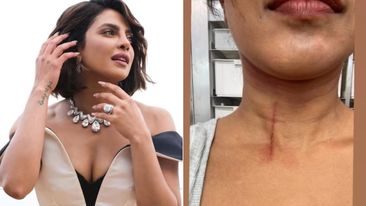 Priyanka Chopra: బ్రేకింగ్ న్యూస్.. షూటింగ్‌లో గాయపడిన ప్రియాంక చోప్రా