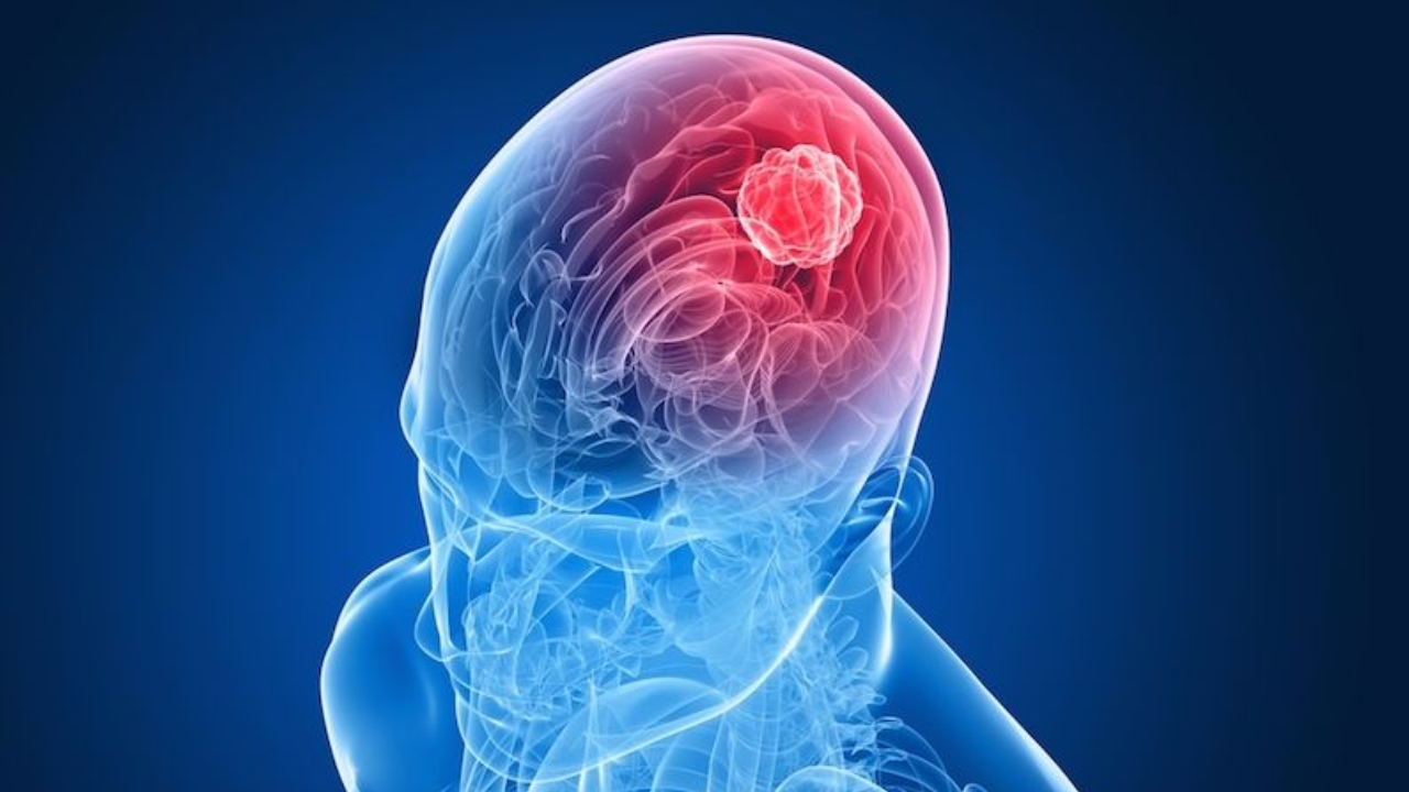 Brain Cancer Symptoms: మీలో ఈ లక్షణాలు ఉన్నాయా.. అయితే జాగ్రత్త.. మెదడు క్యాన్సర్ వచ్చే ప్రమాదం