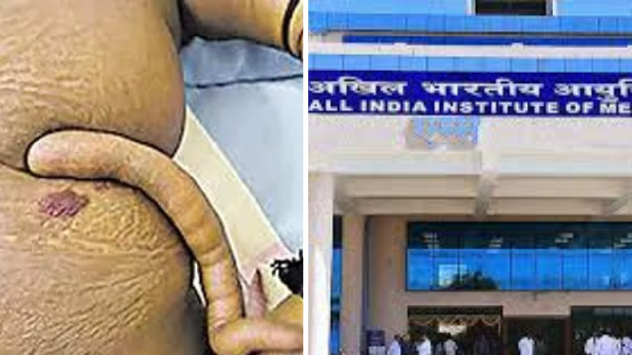 Rare Surgery in AIIMS Bibinagar: అరుదైన శస్త్ర చికిత్స.. బాలుడికి తోకని తొలగించిన ఎయిమ్స్‌ వైద్యులు..!