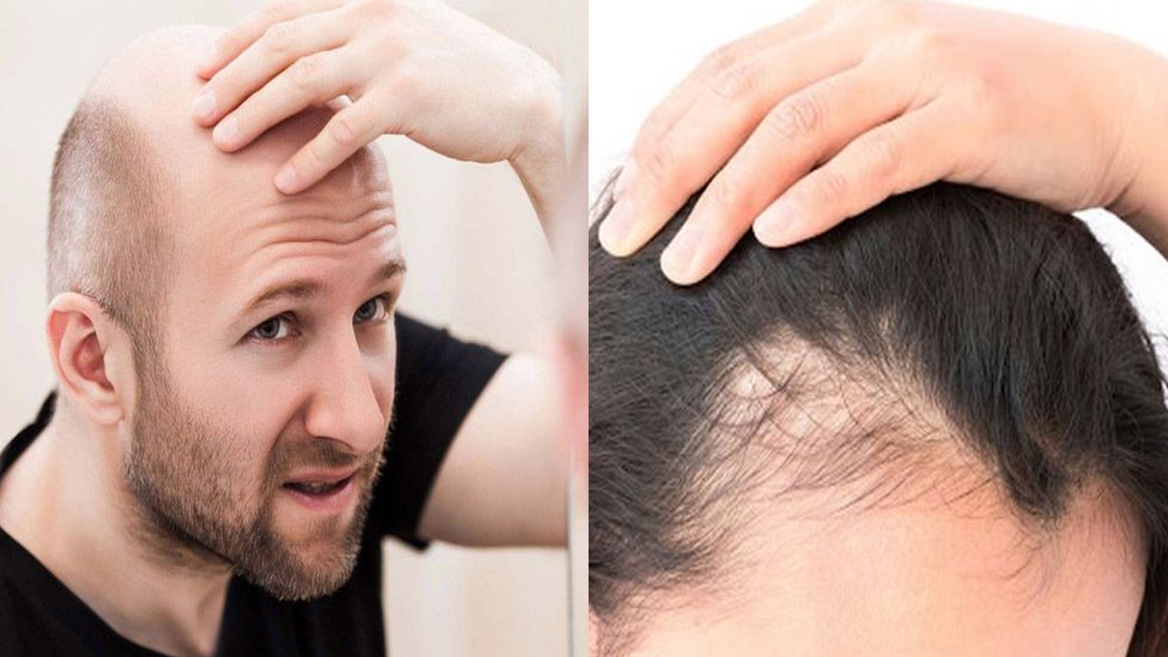 Hair Fall Tips: జుట్టు ఎక్కువగా రాలి బట్టతల వస్తుందా? ఈ జాగ్రత్తలు పాటించండి!