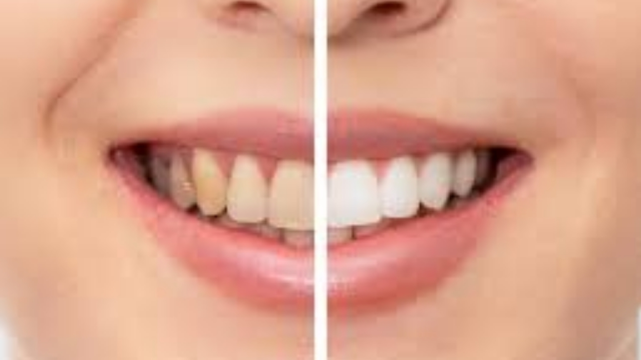 Remedies For Teeth Whitening: దంతాలు పసుపు రంగులో ఉన్నాయని ఇబ్బంది పడుతున్నారా.. ఈ చిట్కాలు వాడి మెరిపించేయండి