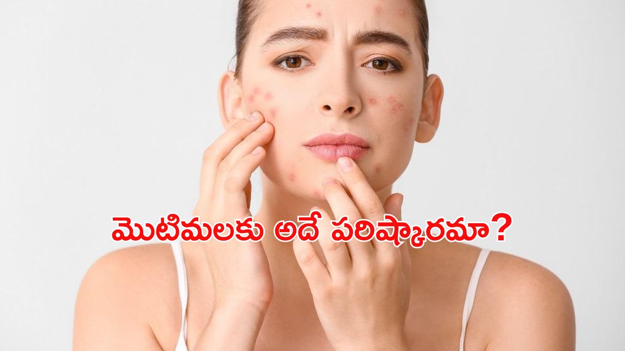 Omega 3 Fatty Acids: ఒమేగా 3 ఫ్యాటీ యాసిడ్స్ తో ముఖంపై మొటిమలు పోతాయా ?