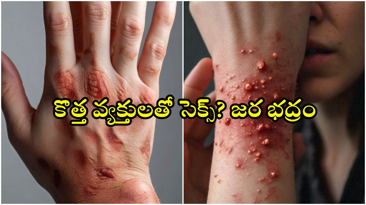 Mpox in Hyderabad: భయపెడుతున్న ఎంపాక్స్ వైరస్.. హైదరాబాద్‌కు ముప్పు?