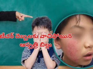 China Schoolboy Vitiligo: టీచర్ చేసిన పనికి.. ఆ విద్యార్థికి వింత చర్మ వ్యాధి, మరీ అలా శిక్షిస్తే ఎలా బాస్?