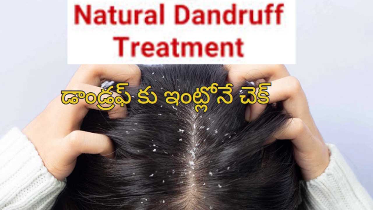 Home Remedies For Dandruff : డాండ్రఫ్ తో బాధపడుతున్నారా?.. ఈ చిట్కాలు మీ కోసమే..