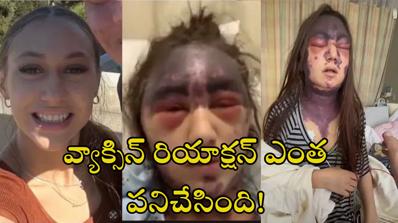 Alexis Lorenze Viral: టెటనస్ వ్యాక్సిన్ తీసుకోగానే సీరియస్ రియాక్షన్.. చావుబతుకుల్లో యువతి