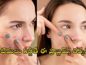 Popping pimples Side Affects: మొటిమలను గిల్లితే ఈ సైడ్ ఎఫెక్ట్స్ తో ప్రమాదం.. మీ అందం కాపాడుకోండిలా..