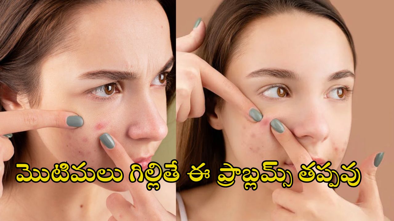 Popping pimples Side Affects: మొటిమలను గిల్లితే ఈ సైడ్ ఎఫెక్ట్స్ తో ప్రమాదం.. మీ అందం కాపాడుకోండిలా..