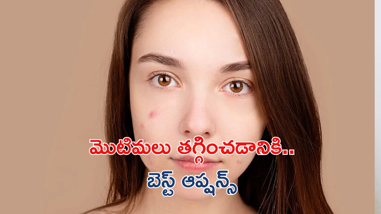 Pimples Removal Tips:మొటిమలు తగ్గడానికి ఇవే బెస్ట్ ఆప్షన్స్ !