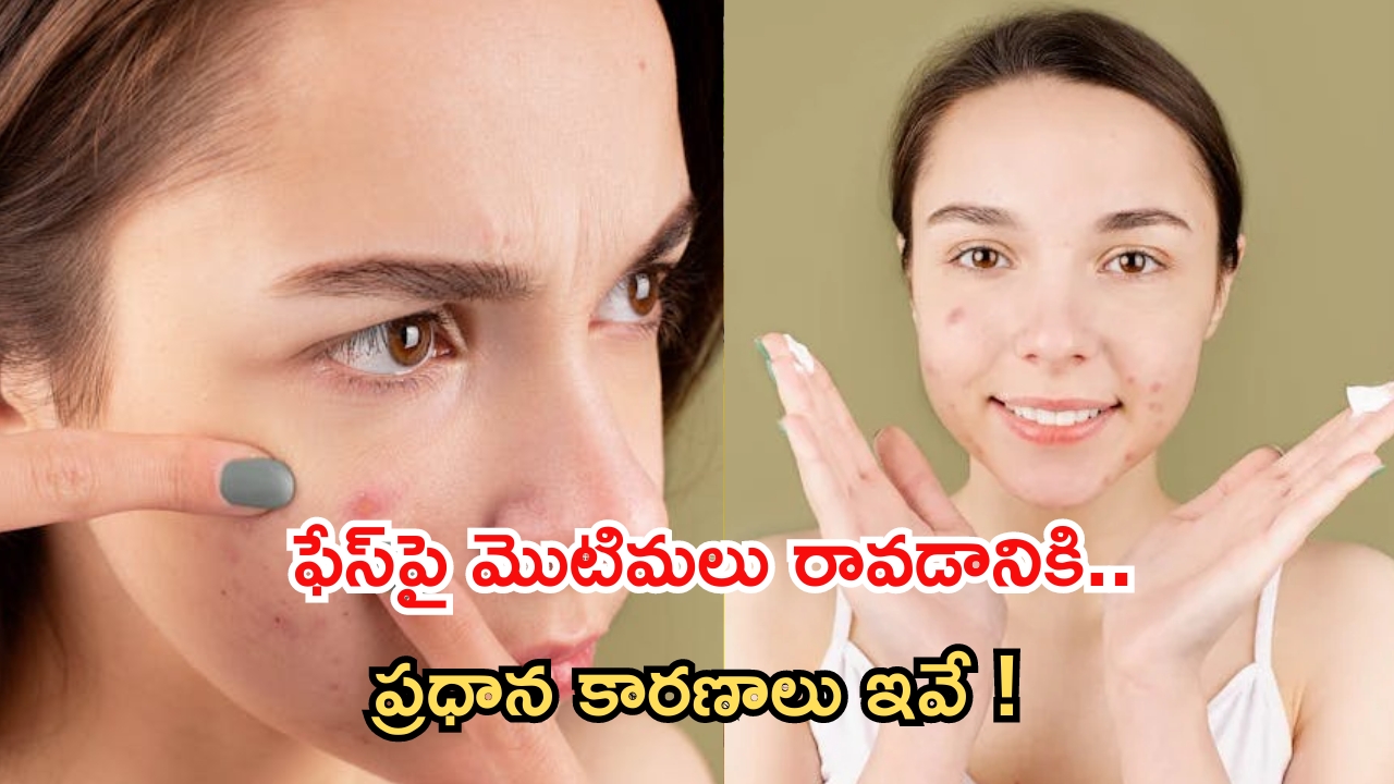 Causes Of Pimples: మొటిమలు రావడానికి కారణాలు ఇవే !