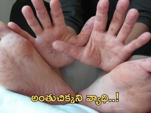 Hand Foot Mouth: రాష్ట్రంలో ‘హ్యాండ్ ఫుట్ మౌత్’ కలకలం.. వ్యాధి లక్షణాలు ఇవే!