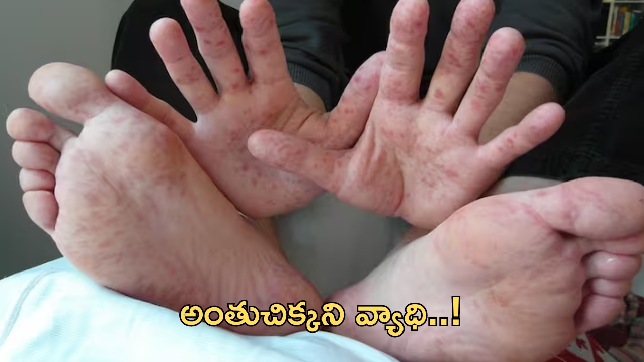 Hand Foot Mouth: రాష్ట్రంలో ‘హ్యాండ్ ఫుట్ మౌత్’ కలకలం.. వ్యాధి లక్షణాలు ఇవే!