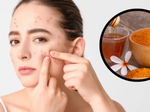 Pimples On Face: వీటిని వాడితే మీ ముఖంపై మొటిమలు రమ్మన్నా.. రావు