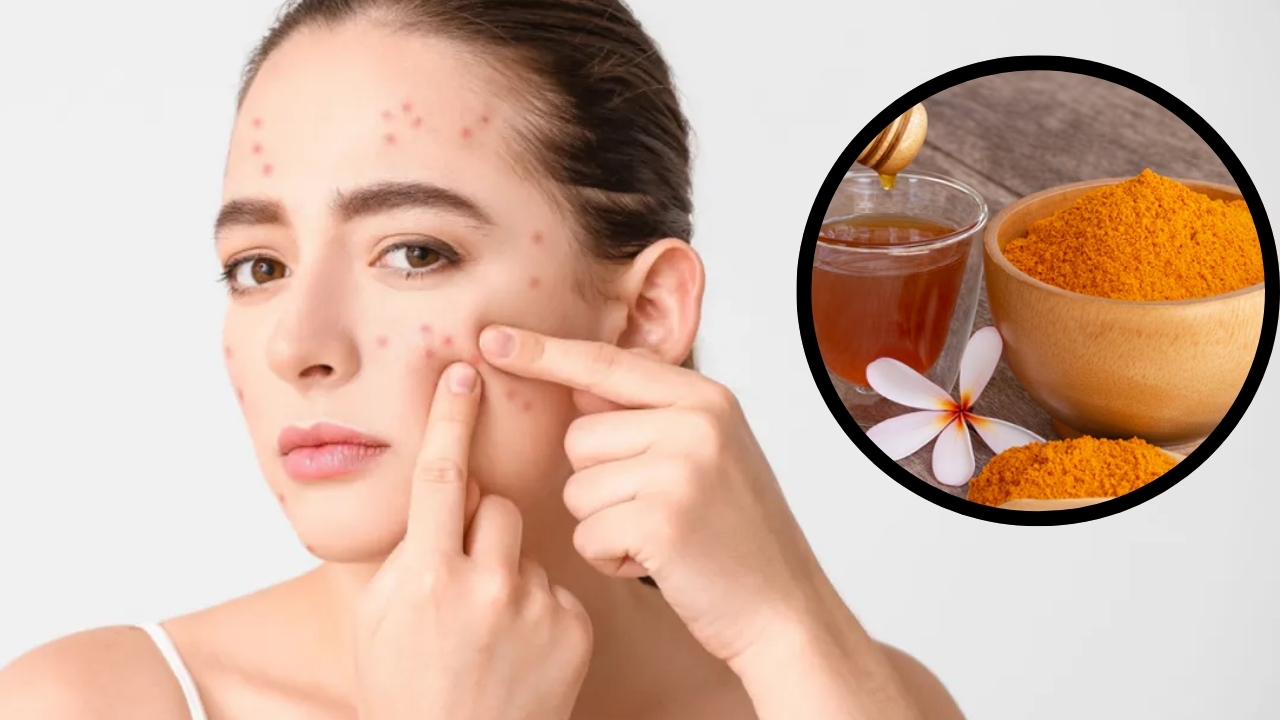 Pimples On Face: వీటిని వాడితే మీ ముఖంపై మొటిమలు రమ్మన్నా.. రావు