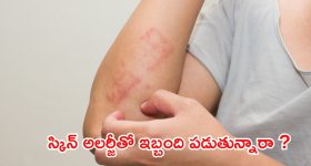 Skin Allergy : స్కిన్ అలర్జీతో ఇబ్బంది పడుతున్నారా ? వీటిని వాడండి