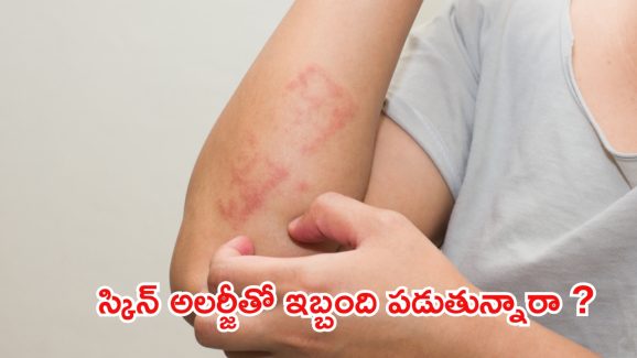 Skin Allergy : స్కిన్ అలర్జీతో ఇబ్బంది పడుతున్నారా ? వీటిని వాడండి