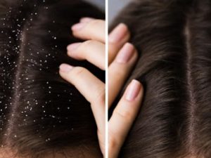 Dandruff: చుండ్రు ఈజీగా తగ్గించుకోండిలా ?