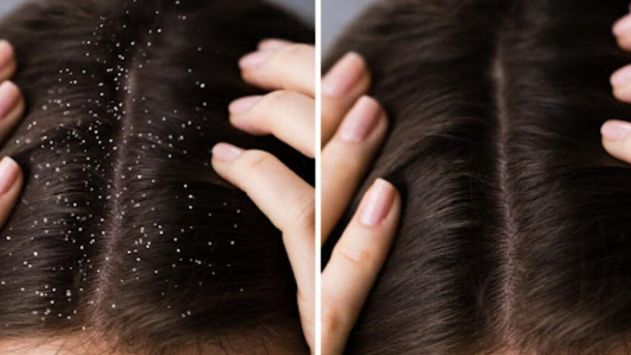 Dandruff: చుండ్రు ఈజీగా తగ్గించుకోండిలా ?