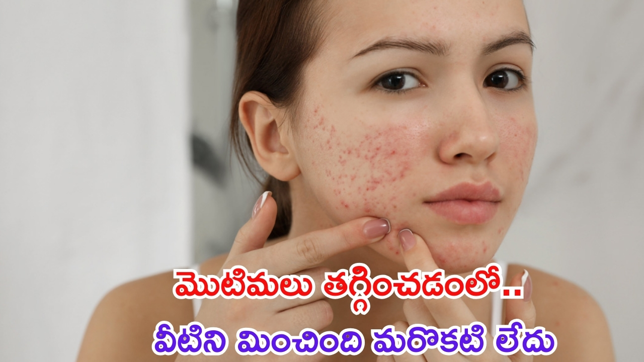 Oily Skin: ముఖంపై మొటిమలను తగ్గించడంలో వీటిని మించింది లేదు