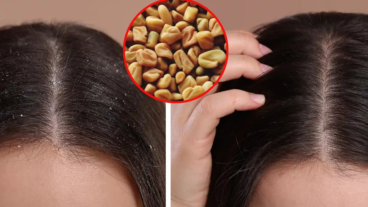 Fenugreek For Dandruff: ఈ గింజలు కొన్ని చాలు.. మీ చుండ్రును పూర్తిగా తగ్గించడానికి !