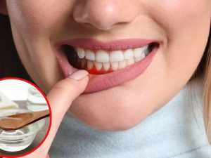 Bleeding Gums: చిగుళ్ల నుంచి రక్తం కారుతోందా ? ఇలా చేస్తే సమస్య దూరం